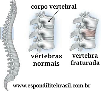 alt="Osteoporose e fraturas vertebrais em espondilite" 