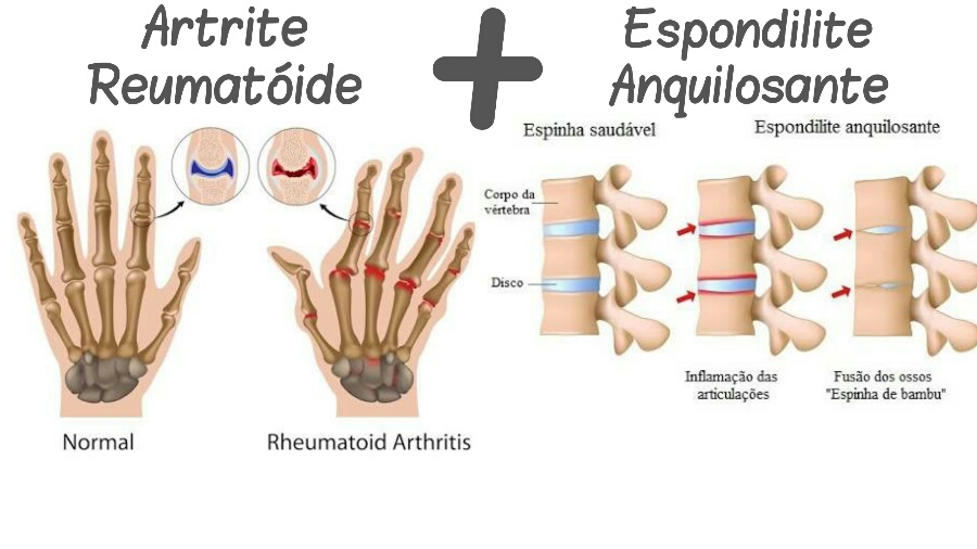alt="Artrite Reumatoide uma Prima da Espondilite Anquilosante" 