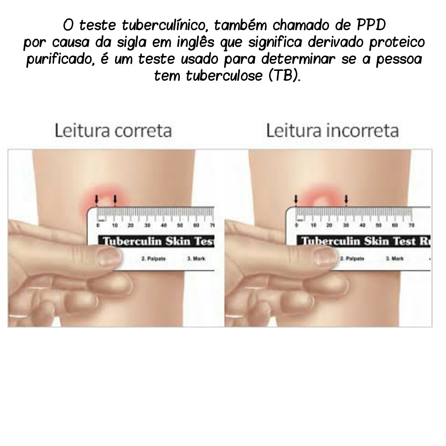 alt="Teste tuberculínico"