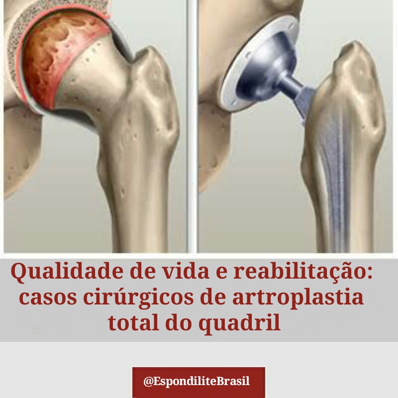 Qualidade de vida e reabilitação: casos cirúrgicos de artroplastia total